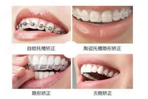 各类牙齿矫正器