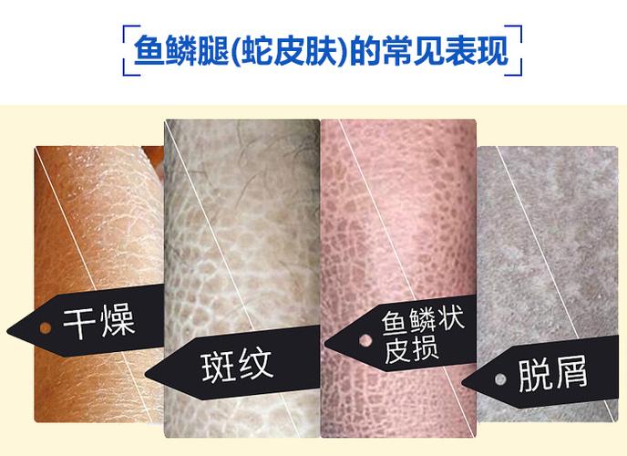 [此网站已认证]蛇皮肤鱼鳞腿该怎么治疗