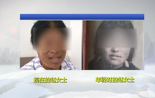 肢端肥大症的病因