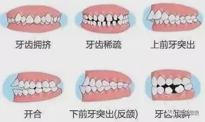 听说每四人中就有一个有牙齿咬合问题