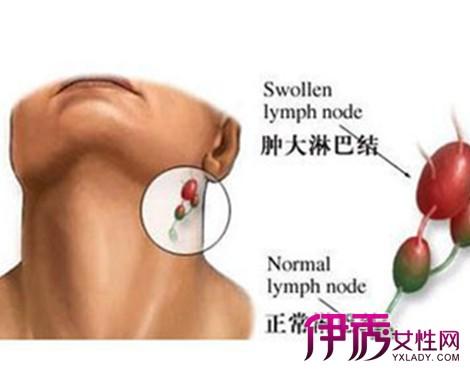【图】脖子皮肤里面有硬块是什么回事 为你介绍淋巴结的症状及原因