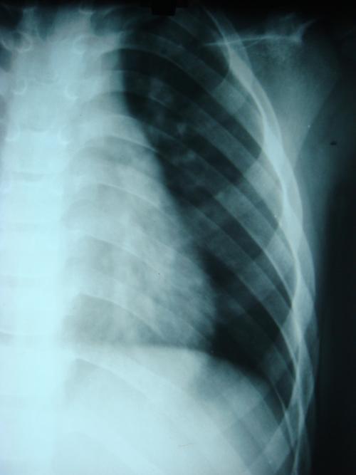 肋骨骨折?为什么ct就扫不出它骨折?这类外伤病人我们