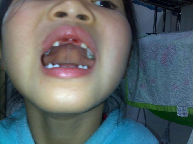 幼小衔接之际大门牙开始掉啦,一口烂牙一颗颗换啦!