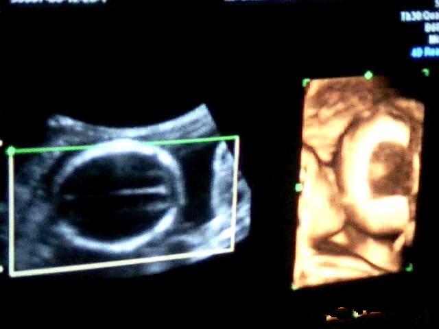 在彩超检查的时候,也要看胎宝宝的配合程度,还有照b超医生的专业水平