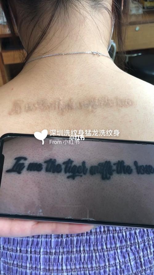 先祛色素在祛疤痕洗纹身洗增生凸起疤痕纹身_纹身_疤痕_深圳攻略_祛疤