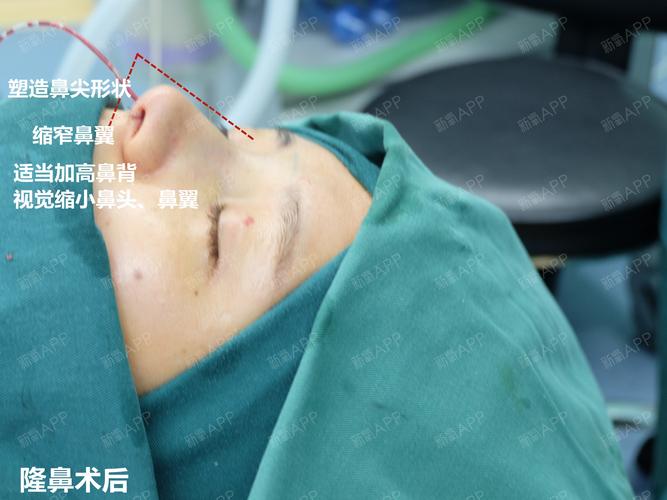 【隆鼻案例分享】瞧小美女一步步颜值逆袭,侧颜杀cool