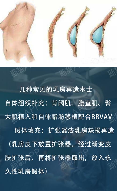 整形外科医生技术高光时刻乳房再造术了解一下 92
