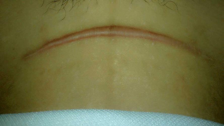 小宝都快11个月了,肚子上的疤痕看起来好