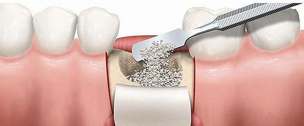 浅谈:患者常见的种植牙答疑(三)