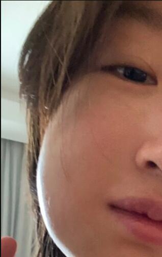 周冬雨拔完智齿脸肿成馒头 原谅我不厚道的笑了