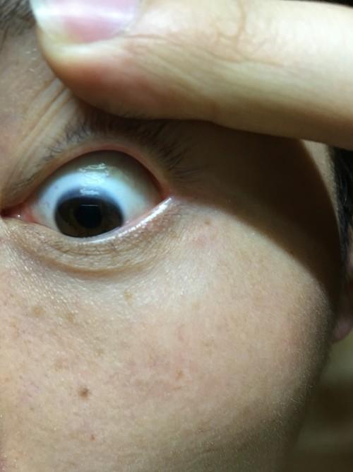 为什么眼球上面黑色变白了,有什么影响.怎么复原