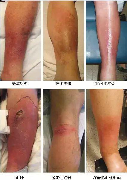 一文掌握蜂窝织炎