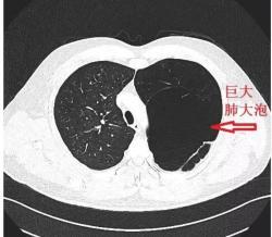 包裹性气胸or肺大泡这里有3个精彩病例