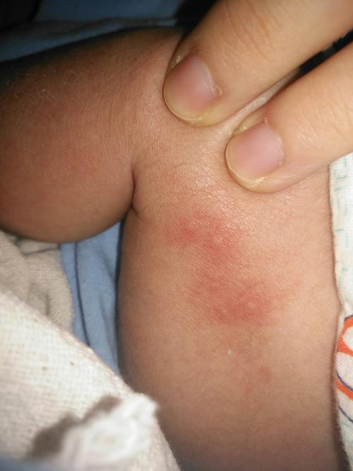宝宝身上老出现这种红疙瘩,这是被什么咬的吗
