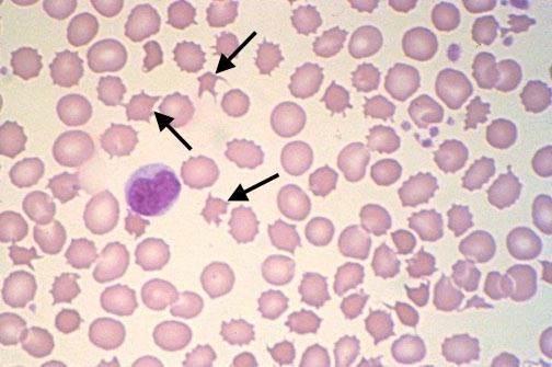 异性红细胞1,靶形,2,棘形,3,小红细胞80.是什么病,严重吗?