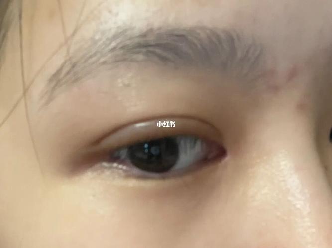 双眼皮20天肉条感_双眼皮_美妆_医美整形