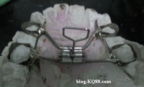 固定扩弓器的制作