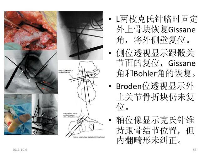 l两枚克氏针临时固定 外上骨块恢复gissane 角,将外侧壁复位.