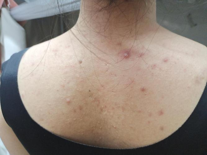 后背长好多痘痘怎么办!