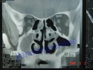 鼻窦ct