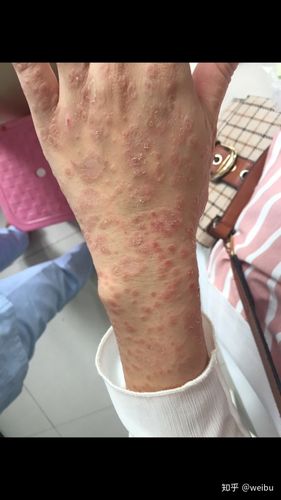 玫瑰糠疹康复过程