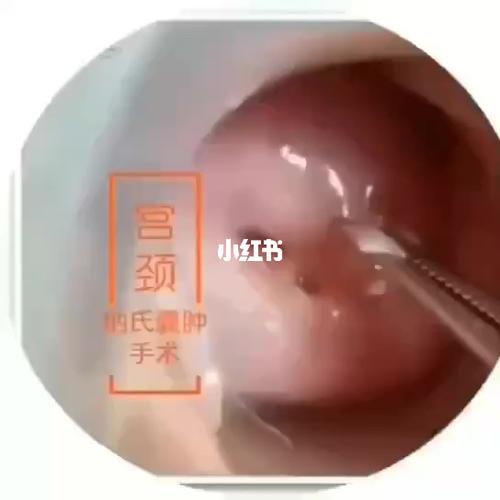 宫颈纳氏囊肿_宫颈纳囊_医疗健康_医疗健康其他