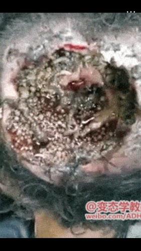 没错,长蛆!(慎入)