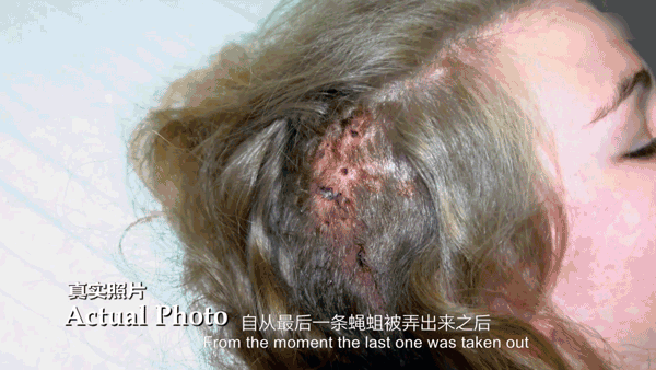 医生从患者的头皮里夹出了蛆
