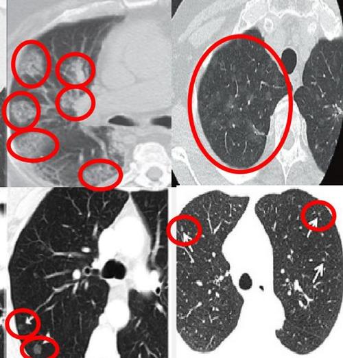 多发肺结节患者为什么