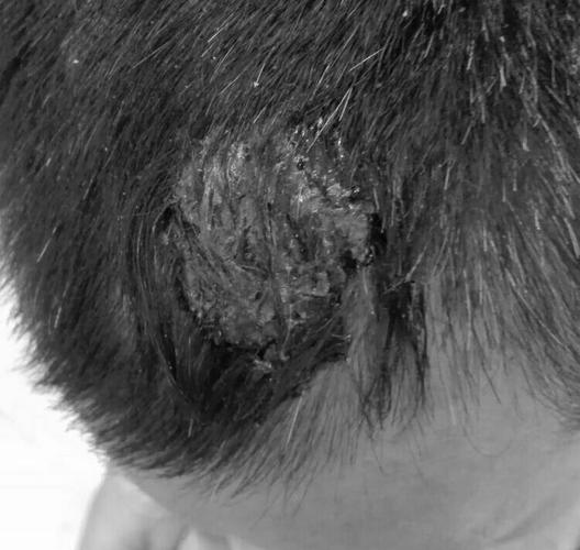 前额长癌怎么办——金台医院神经外科前额头皮癌的处理