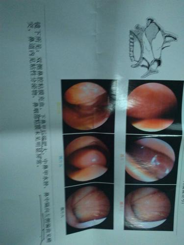 鼻甲肥大同鼻中隔弯曲有什么联系?