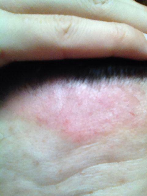 问:额头有一块红斑,到底什么情况啊?