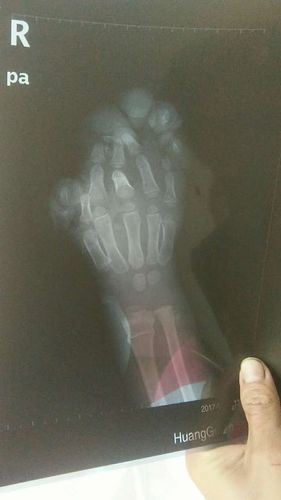 以下照片,是一个4岁男孩右手的ct照,被甘蔗碾压机碾压