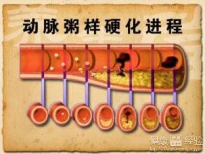动脉硬化如何预防