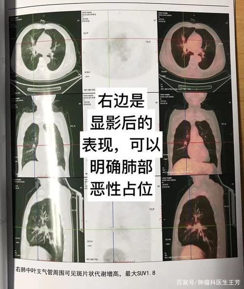 pet-ct是怎么查出肿瘤的