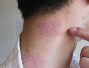 如何判断牛皮癣呢