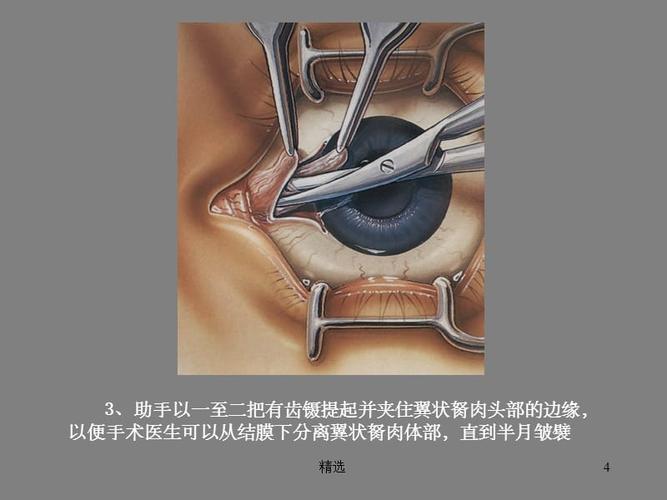 翼状胬肉的手术ppt课件