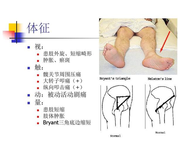 老年髋部骨折(股骨颈骨折,股骨转子间骨折课件)ppt