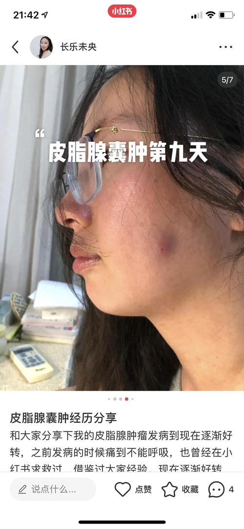 皮脂腺囊肿!亲身经历分享不用开刀!