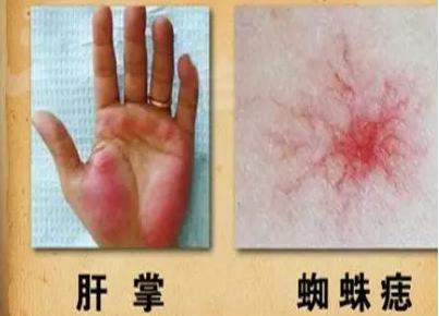 肝病的早期症状二,皮肤发黄 从未患过肝炎的人,肝病患者早期