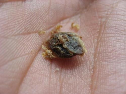 为什么有人"耳屎"是油性的,有的是干的?掏耳屎好吗?你