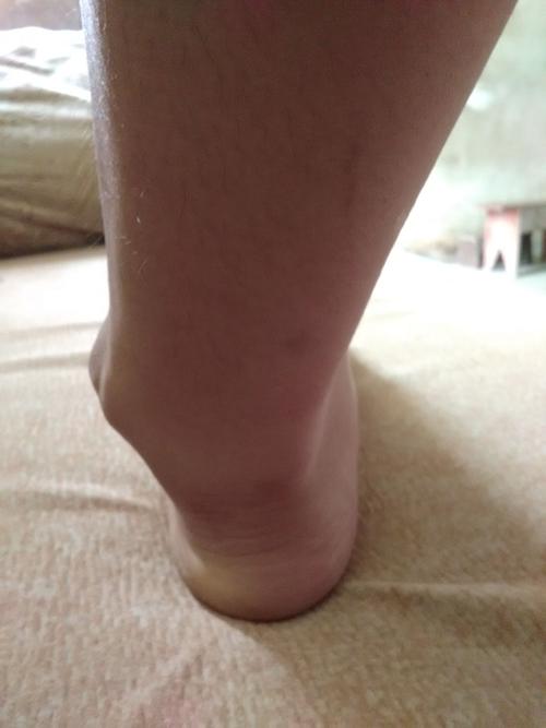 有没有谁知道哪里可以做脚踝畸形的矫正手术啊 ,我是个很要强的女生