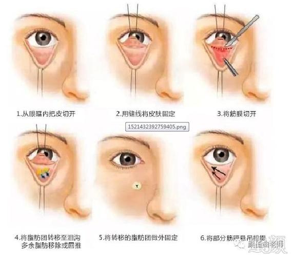 去眼袋后眼窝却凹陷了该怎么修复?