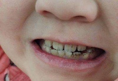 3岁儿子满口小黑牙送去医院检查后医生的话让妈妈万分羞愧