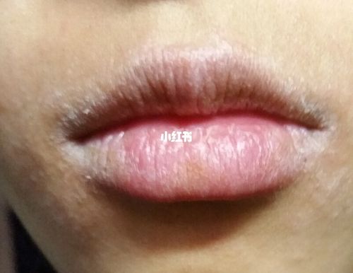 嘴唇发炎,起死皮怎么办?