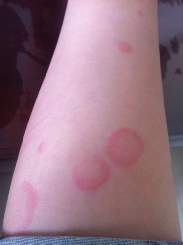 说是环形寻麻疹,半年了,各种输液,抗过敏药都使用了,激素也用了,都没