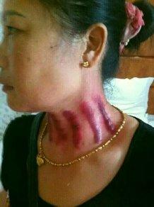 揪痧拔罐释疑(54)——揪脖子痧的适宜范围