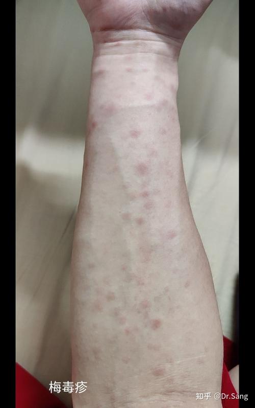 一个hiv病人的梅毒疹