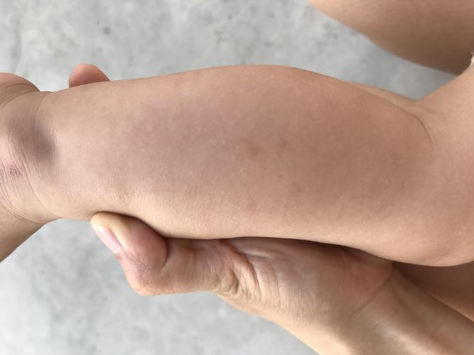 一岁宝宝小腿有这些白色点点的是怎么回事?