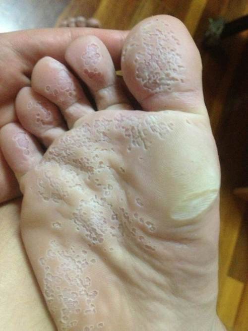脚底脱皮严重像是真菌引起的帮忙看看这个该怎么治疗